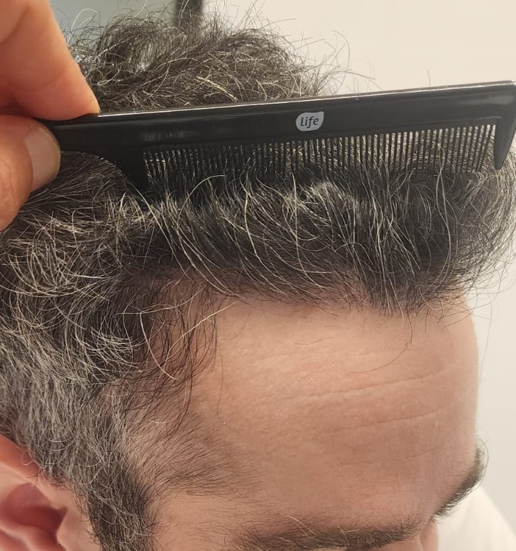 3. Left hairline After.jpg