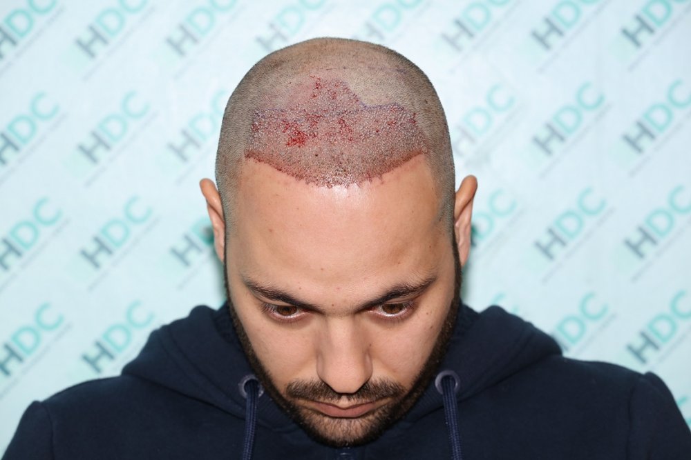3. Post op 2660 - FUE1.JPG