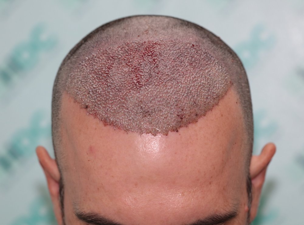 3. Post op 3520 grafts on 14-11-22.JPG