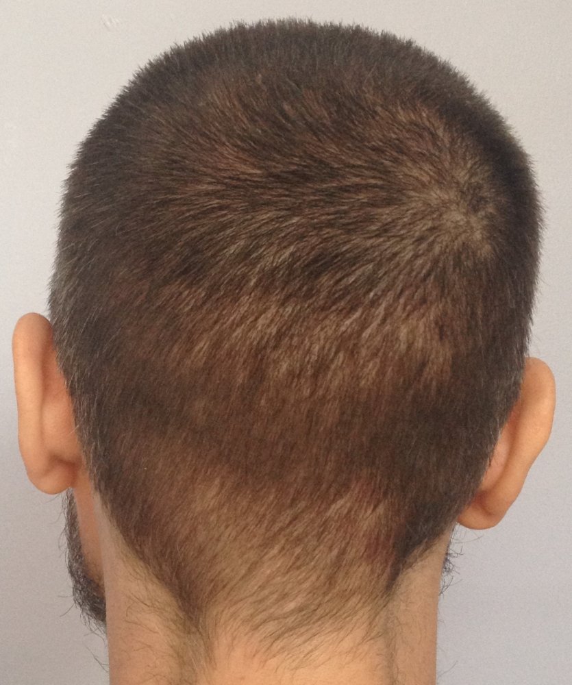 30 days post-op donor.JPG