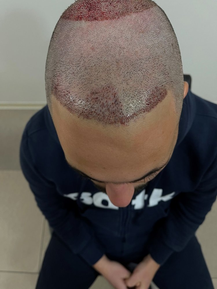 4. 250 grafts to front.jpg