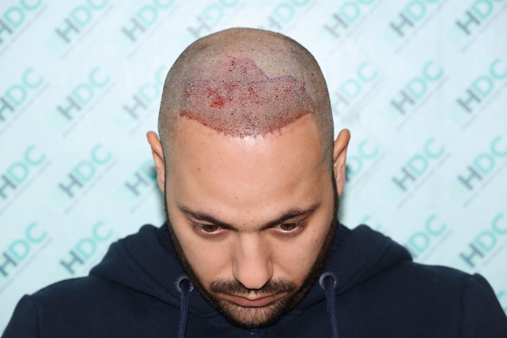 4. 2nd day of surgery for 1127 and total of 2660 grafts.JPG