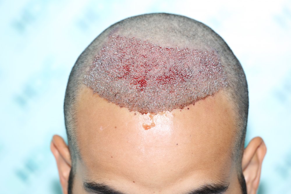 4. 3200 grafts.JPG