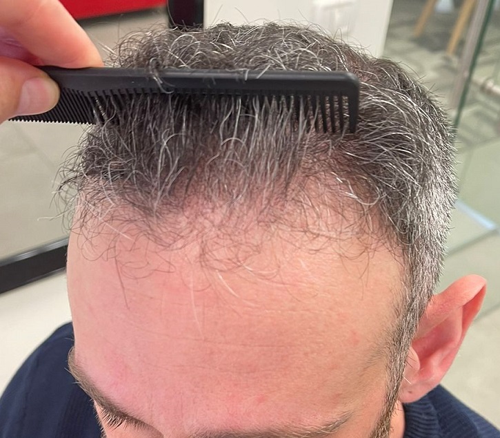 4. Left hairline before.jpg