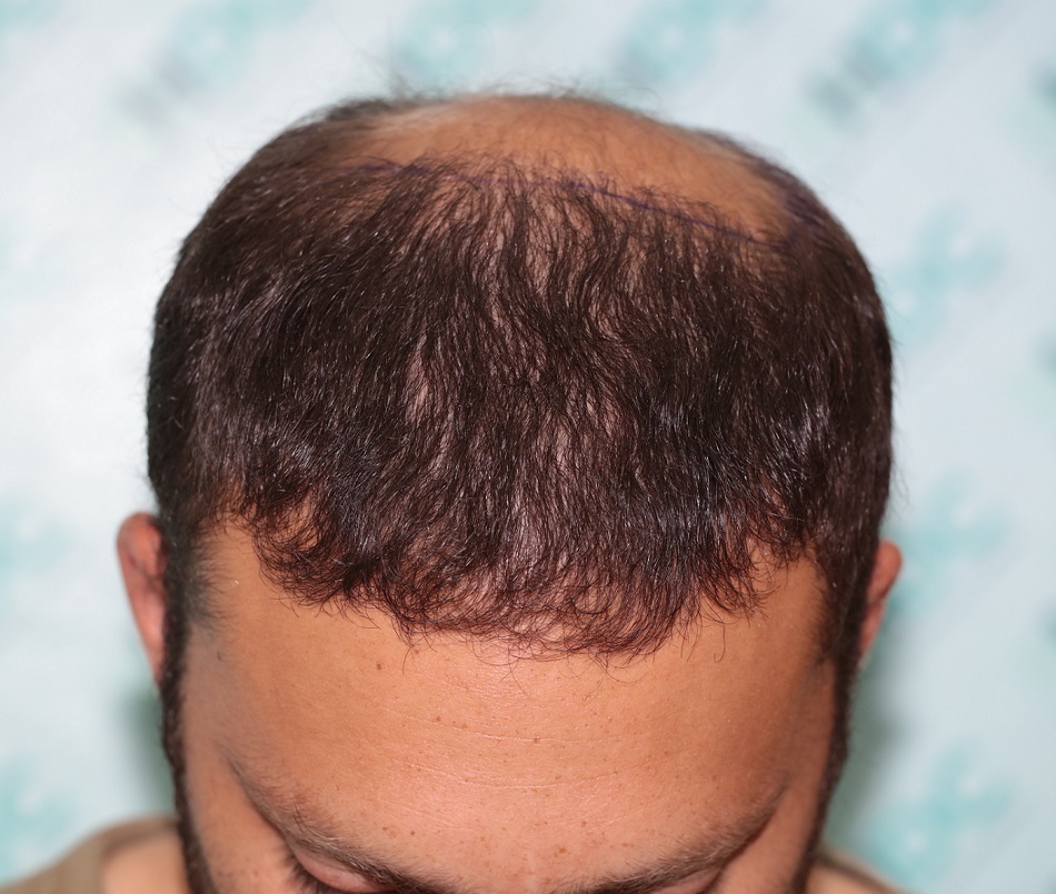 4. Result of FUE1.JPG