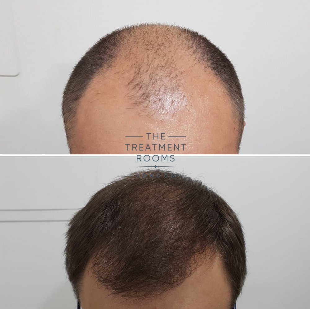 4000 graft Hair transplant result.jpg