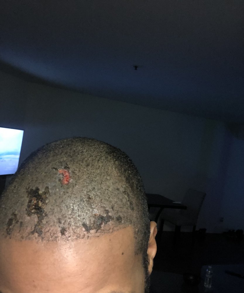 Possible Hairtransplant Necrosis or a mixture? Hair loss Forum