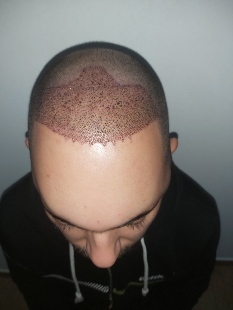 5. 1st day after surgery.jpg