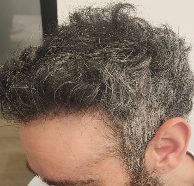 5. Left hairline after.jpg