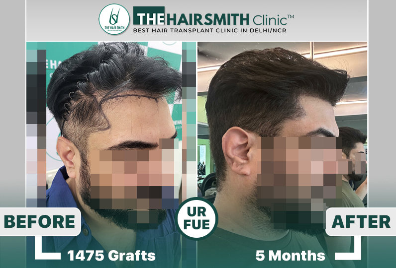 5 months hairsmith hair transplant result - The Hairsmith Clinic - #HairTransplant #The Hairms...JPG