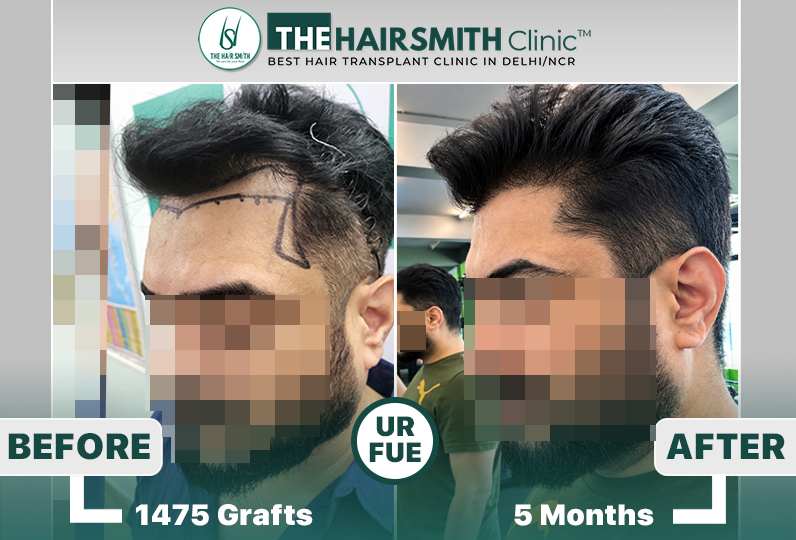 5 months hairsmith hair transplant result - The Hairsmith Clinic - #URFUEHairTransplant #The H...JPG