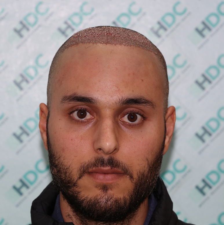 5. Post op full face.JPG