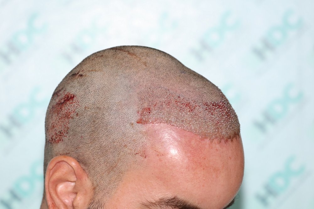 5. Post op  - Right.JPG