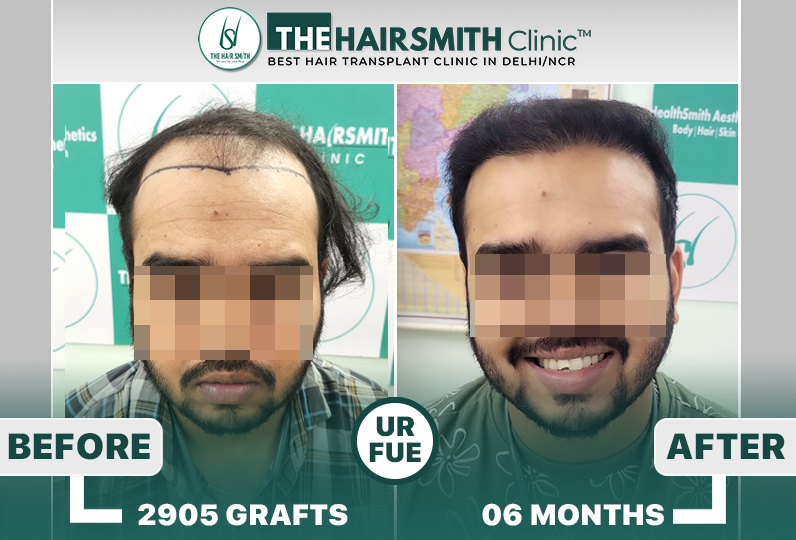 6 months hairsmith hair transplant result - The Hairsmith Clinic - #HairTransplant #The Hairms...JPG
