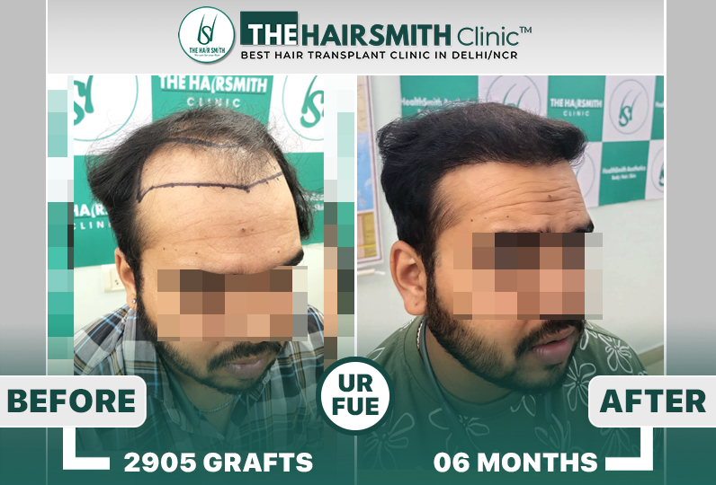 6 months hairsmith hair transplant result - The Hairsmith Clinic - #HairTransplant #The Hairms...JPG