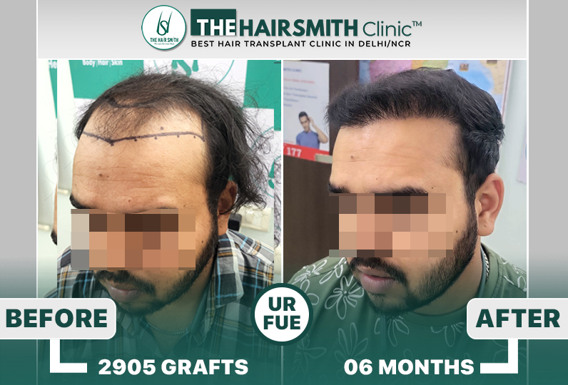 6 months hairsmith hair transplant result - The Hairsmith Clinic - #HairTransplant #The Hairms...JPG