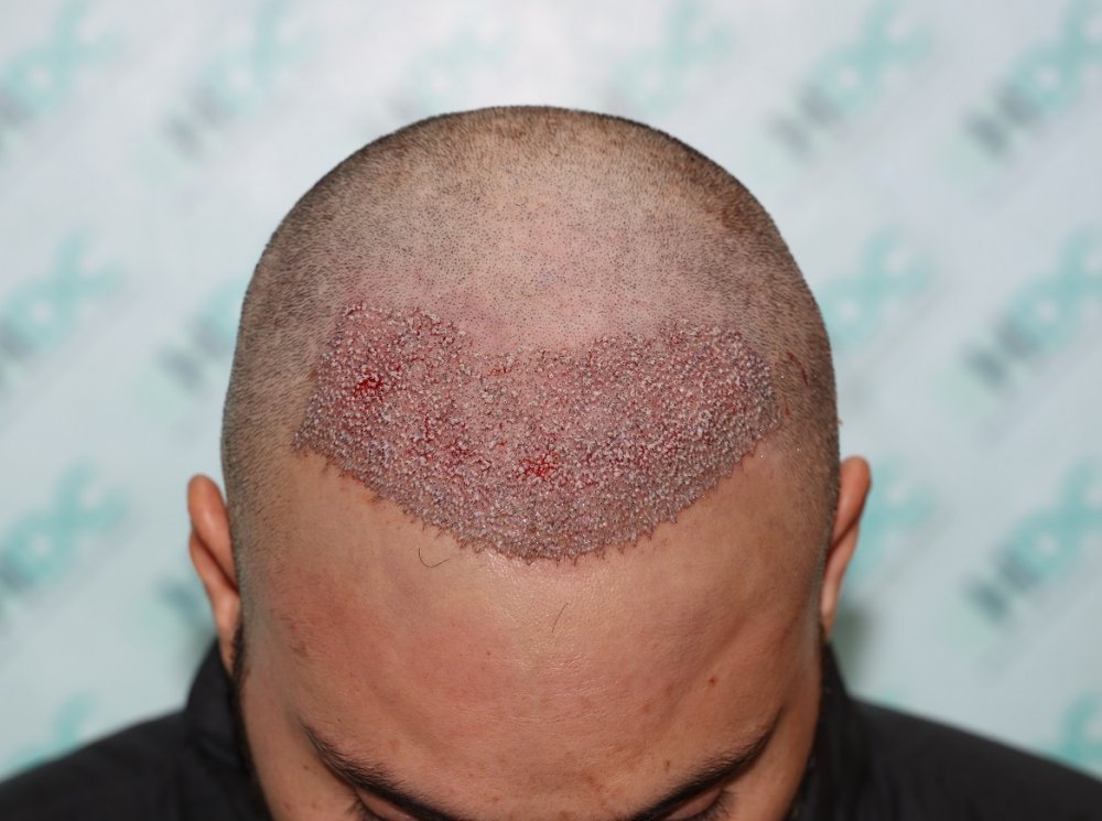 6. Post op  - 3050 grafts.JPG