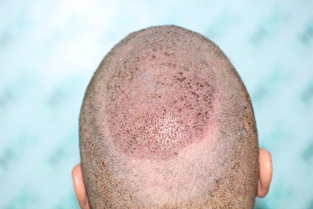 6. Post op FUE2 for 4050 grafts - Crown.JPG