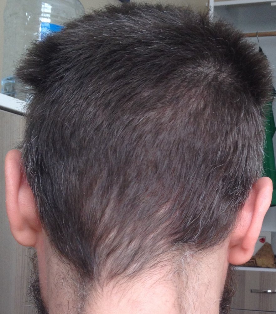 60 days post-op donor.JPG