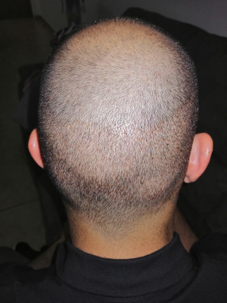 7.1 Back Donor 4 days after.jpg