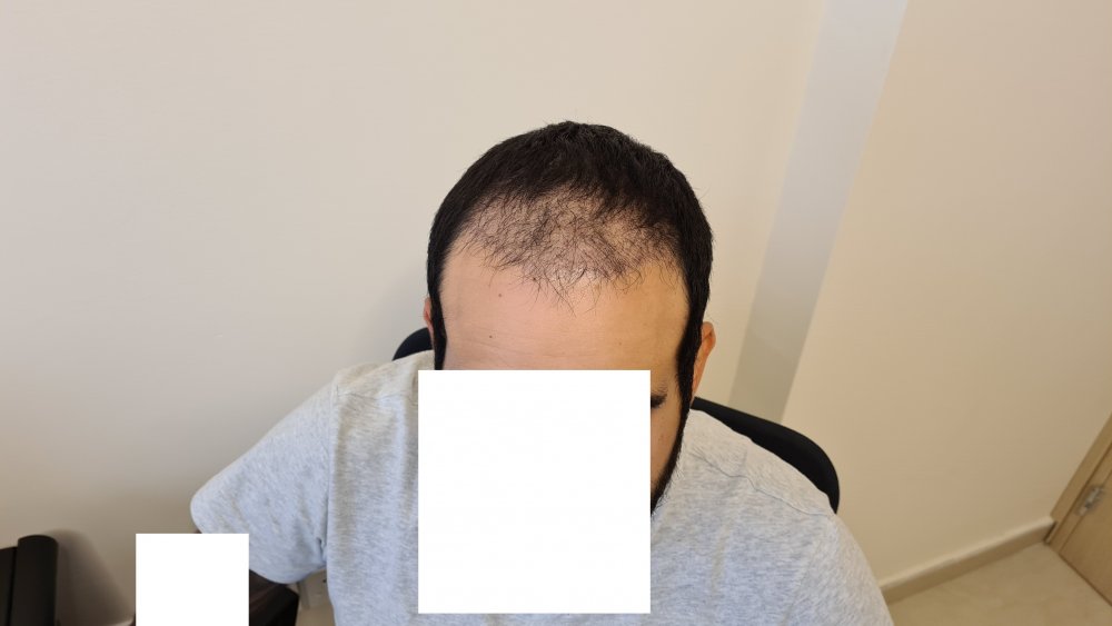 7. 2 months after.jpg