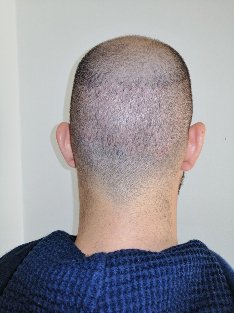 8.1 Back Donor 5 days after.jpg