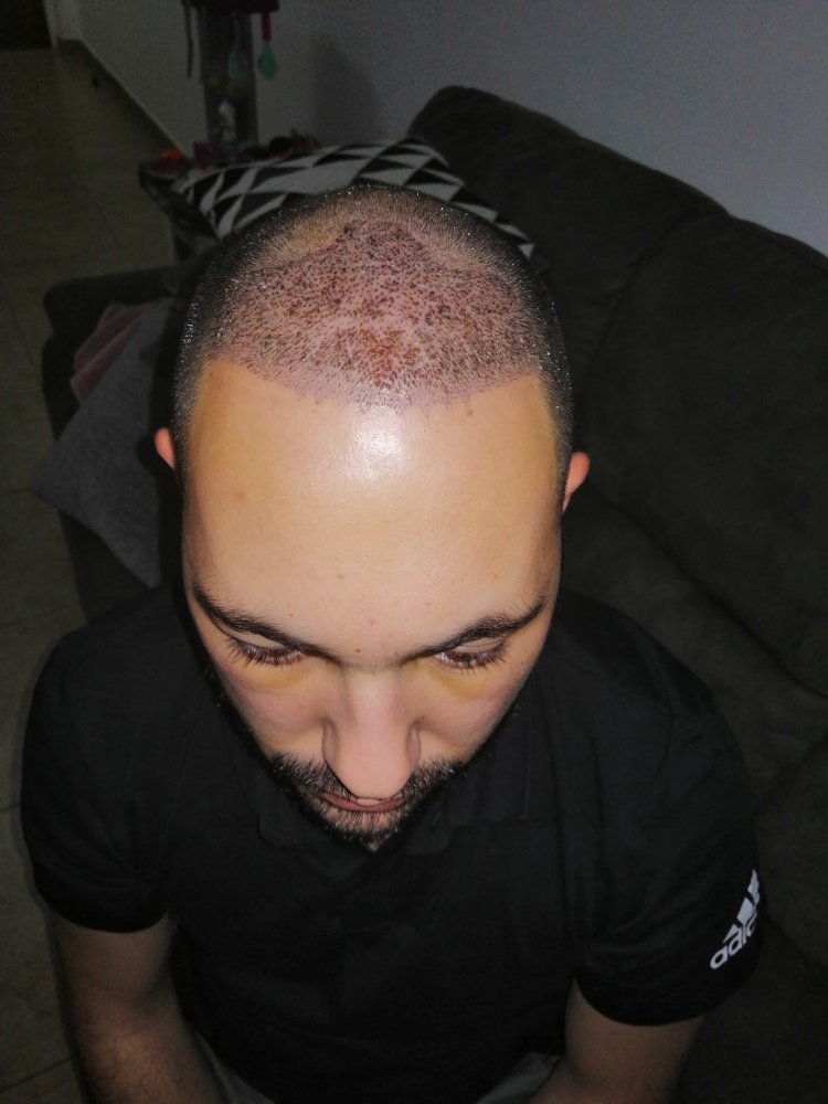 8. 4th day after surgery.jpg