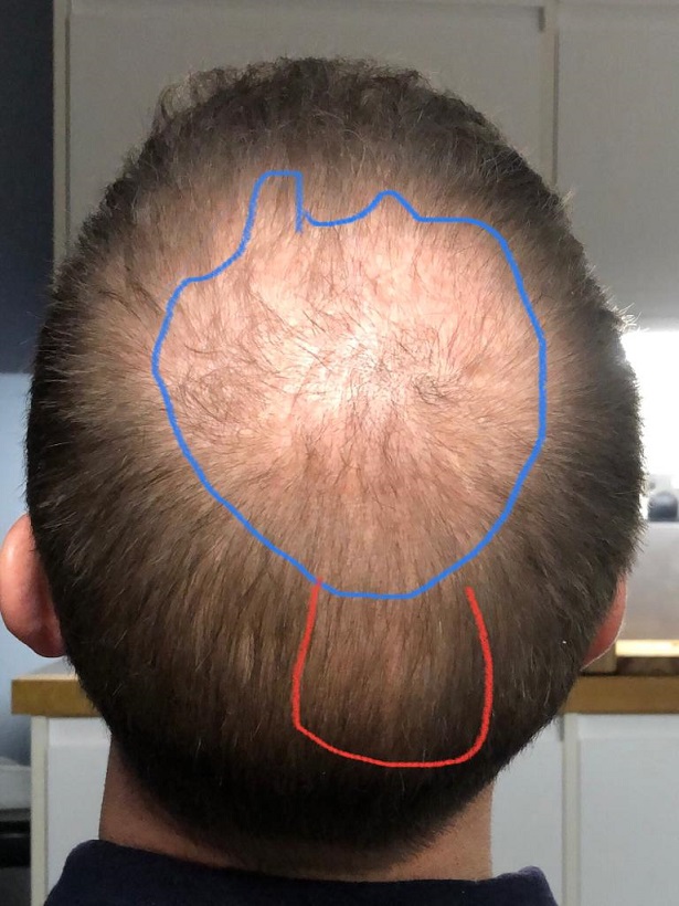 8. Before FUE2 for crown - To cover only blue marking.jpg