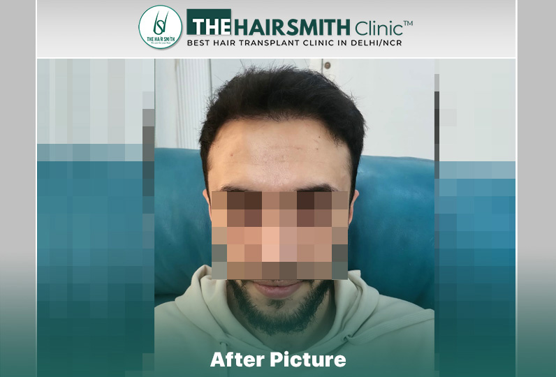 8 months hairsmith hair transplant result - the hairsmith clinic delhi #hairtransplant.JPG