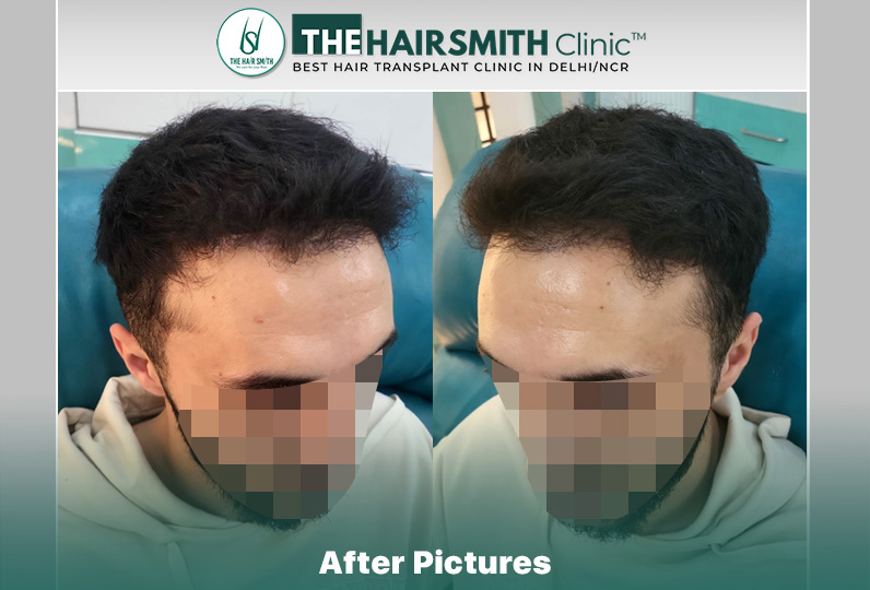 8 months hairsmith hair transplant result - the hairsmith clinic delhi #hairtransplant #thehai...JPG