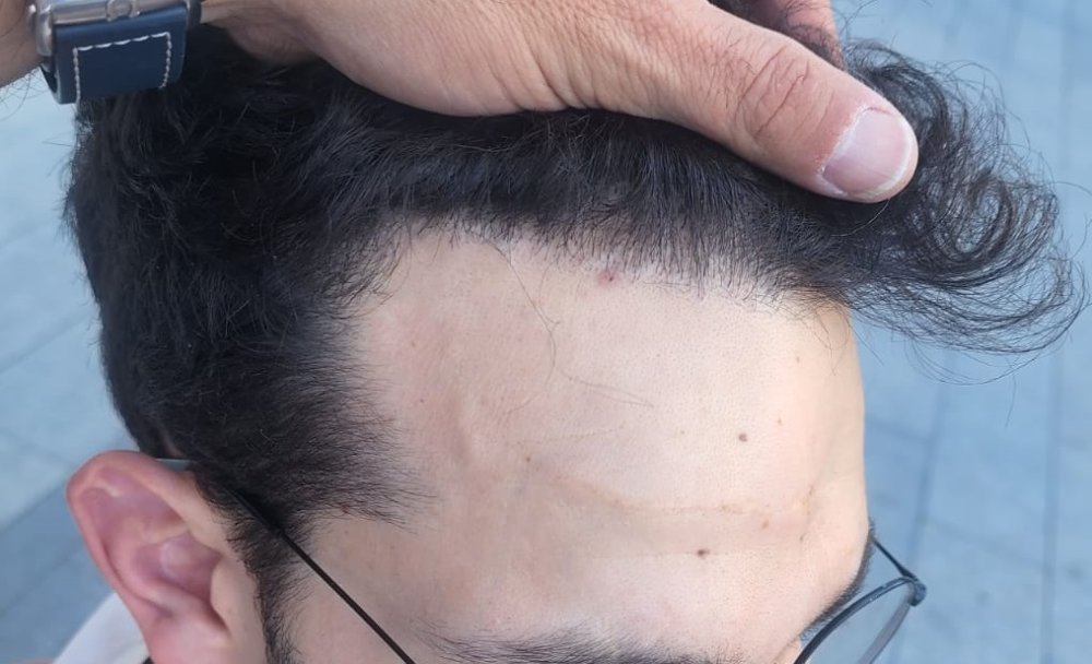 8. Natural Hairline.jpg