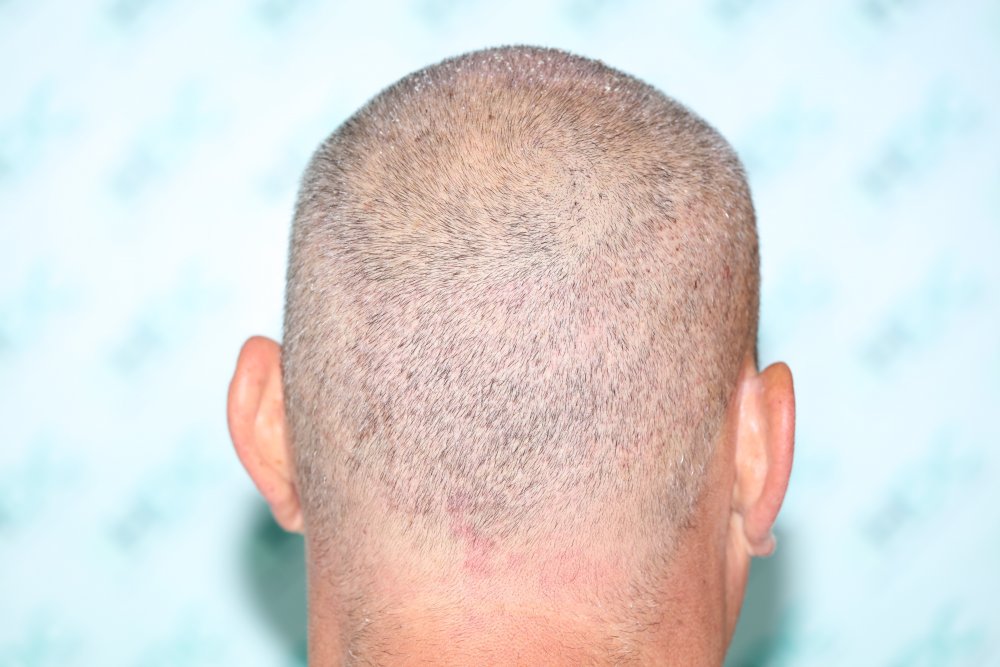 8. Post op Donor - 5 days after FUE2.JPG
