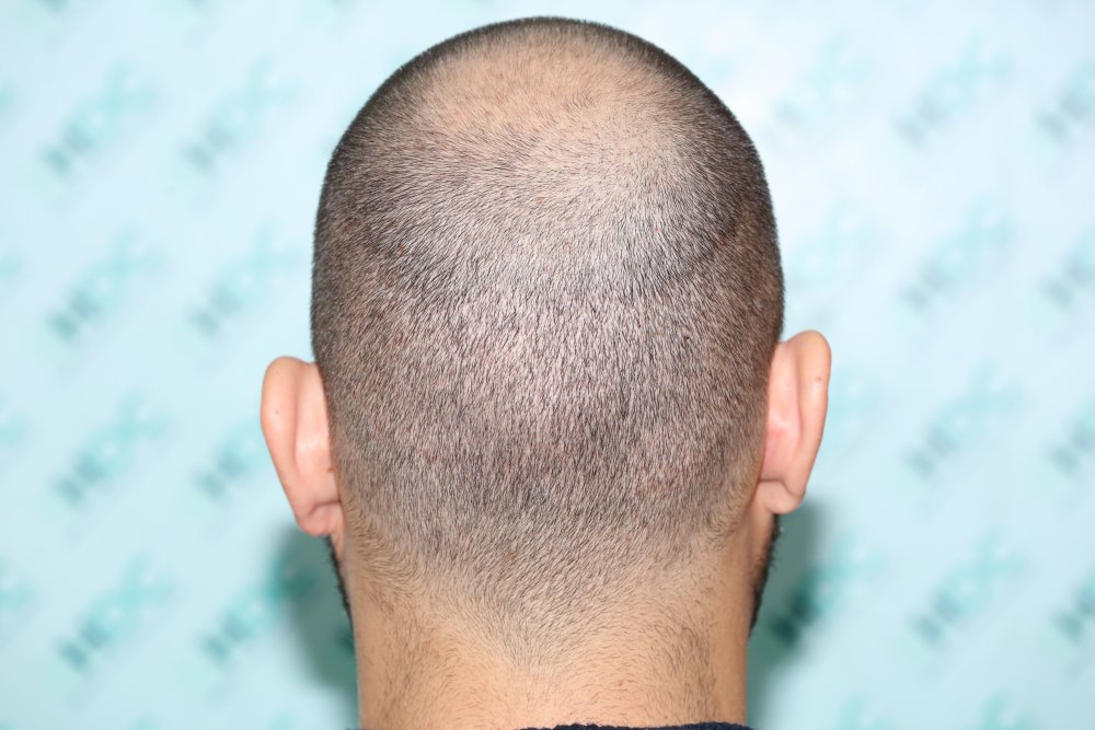 9.1 Back Donor 6 days after.JPG