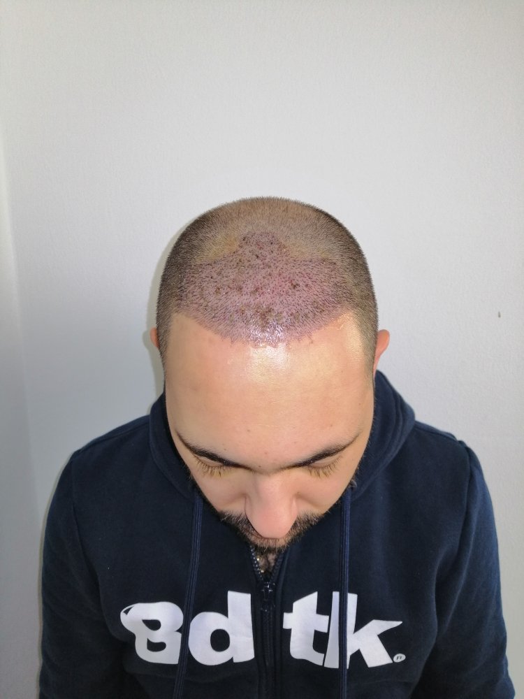 9. 5th day after surgery.jpg
