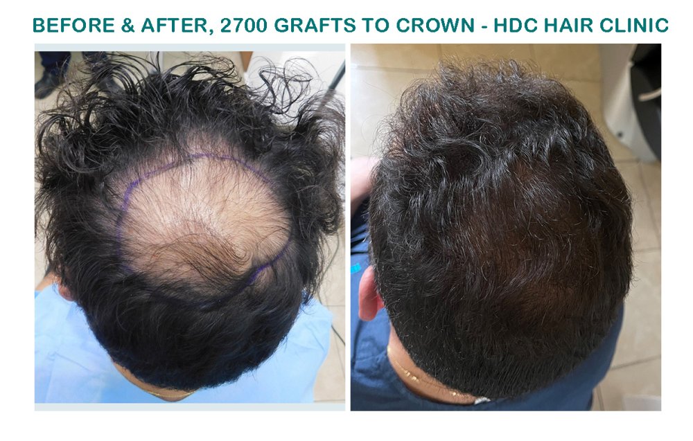 9.  Crown - Aristos 01-02-22 for 2700 grafts.jpg