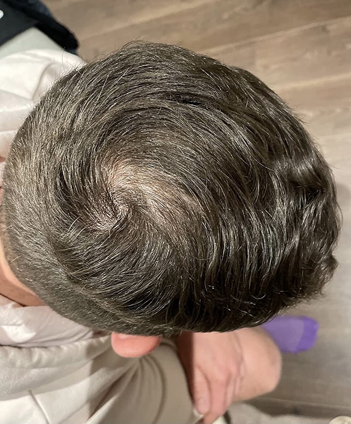 Hair fibers Hair loss Forum Hair Transplant forums
