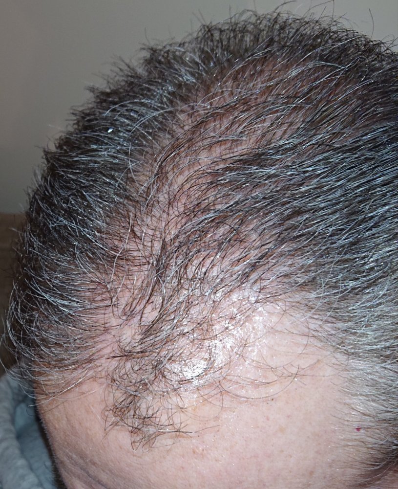 My HT story | Page 2 | Hair loss Forum - Hair Transplant forums