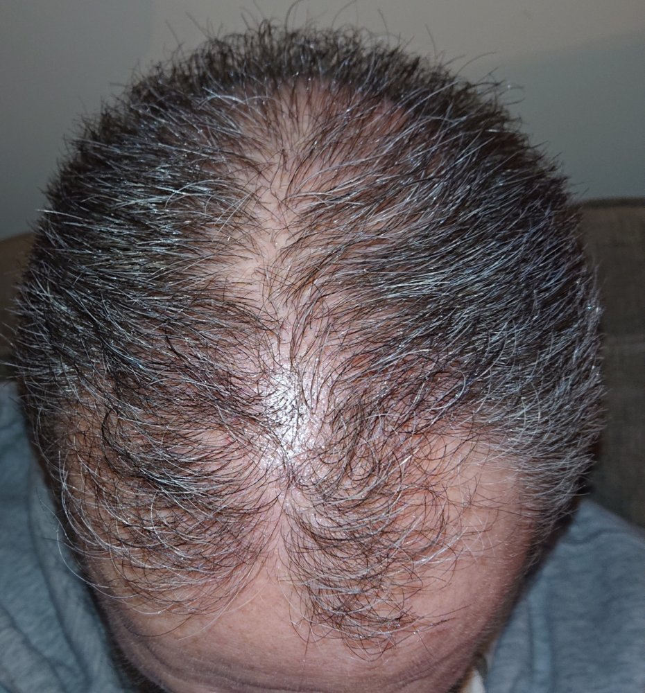 My HT story | Page 2 | Hair loss Forum - Hair Transplant forums