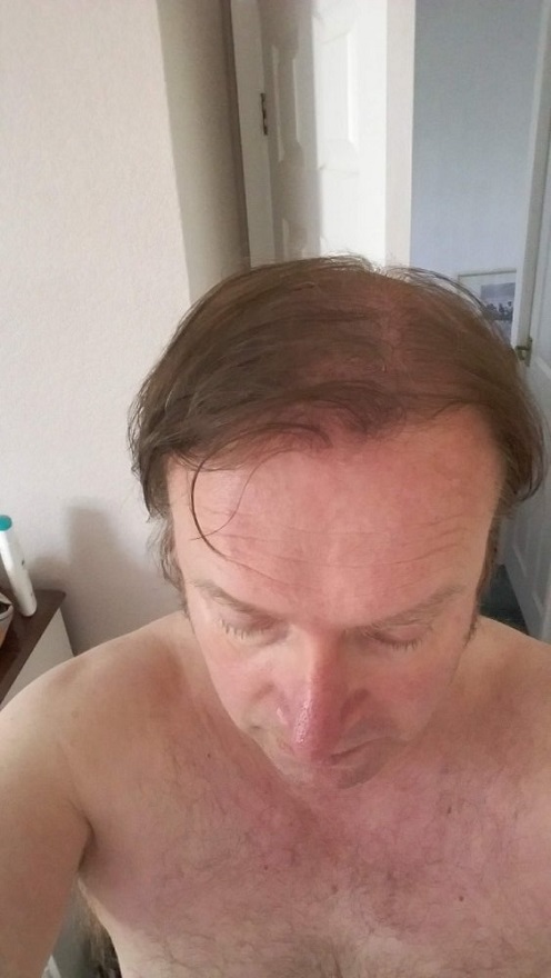 AEK Hair Transplant.jpg