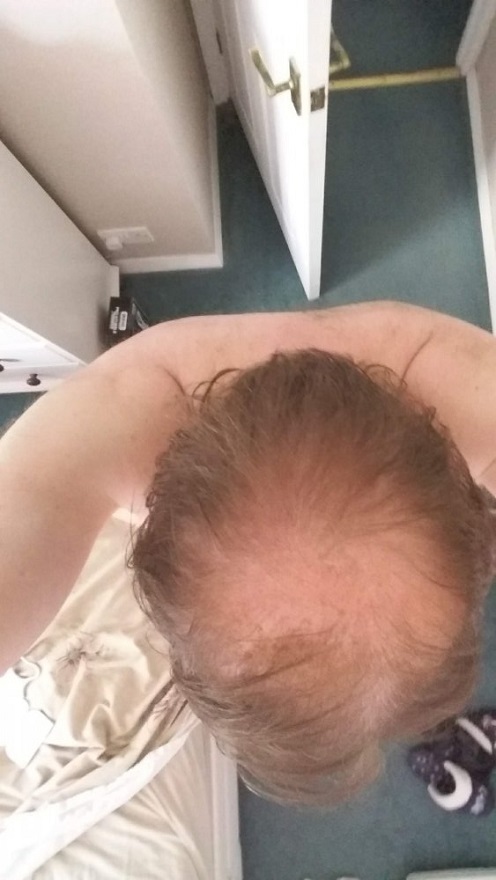 Aek Hair transplant1.jpg