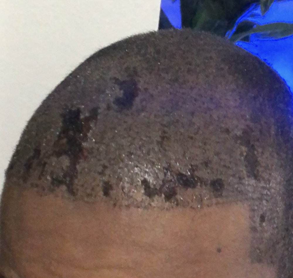 Possible Hairtransplant Necrosis or a mixture? Hair loss Forum