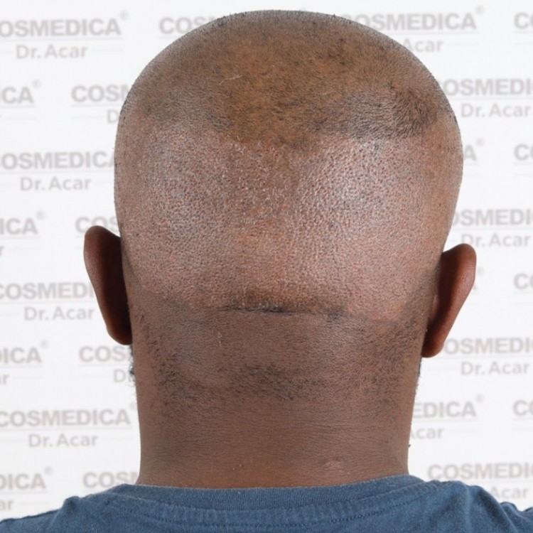 Afro hair transplant, Dr Acar Cosmedica 10.jpeg