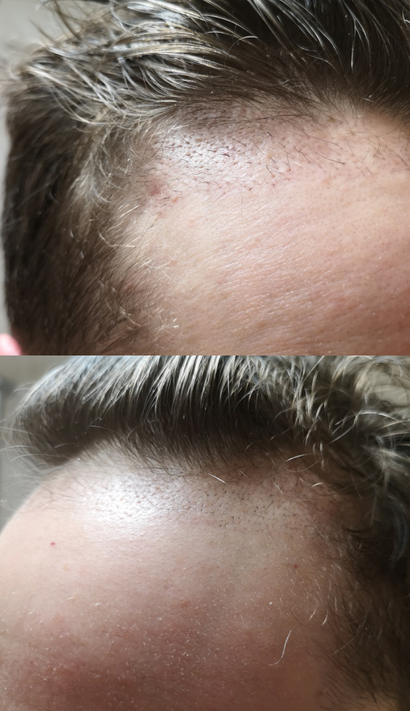 After (4 months).png