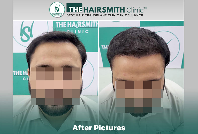 After Hair Transplant Result - 6 months.jpg