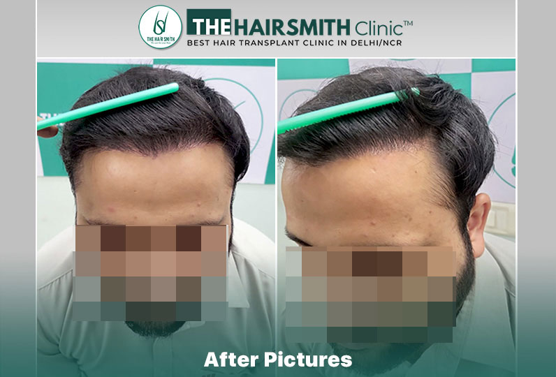 After Hair Transplant Result - 6 Months Update.jpg