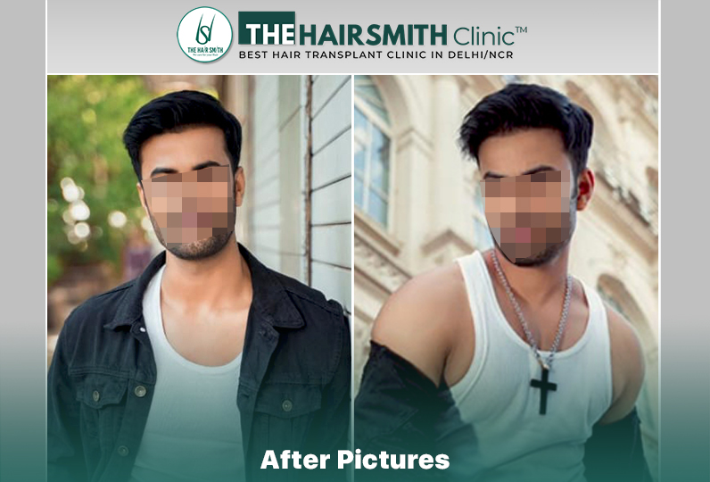 After Hair Transplant Result - 8 months.jpg
