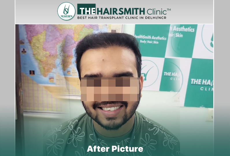 after hair transplant result - the hairsmith clinic delhi india #HairTransplant #URFUEHairTran...jpg