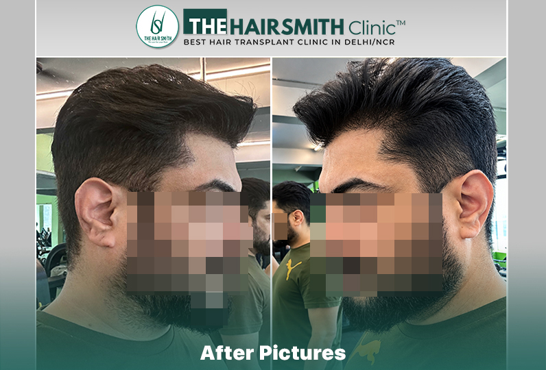 after hair transplant result - the hairsmith clinic delhi india #HairTransplant #URFUEHairTran...JPG