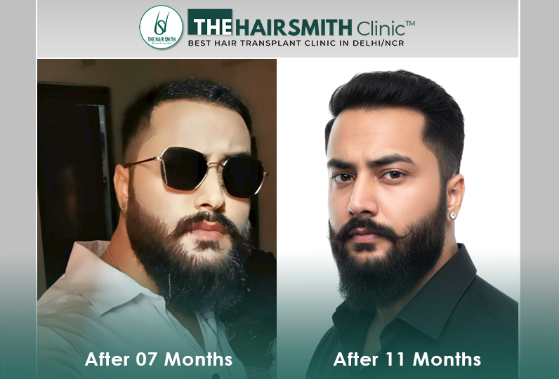 after hair transplant result - the hairsmith clinic delhi.jpg