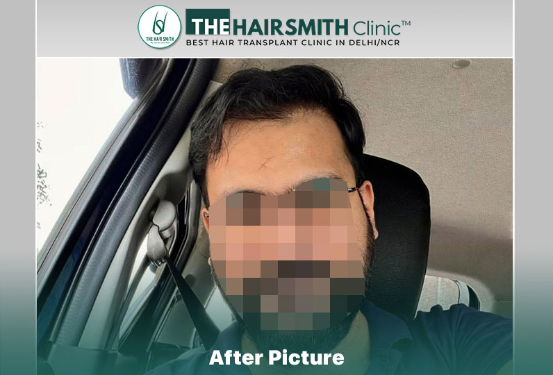 after hair transplant - the hairsmith clinic delhi india #hairtransplant #thehairsmithclinic #...jpg
